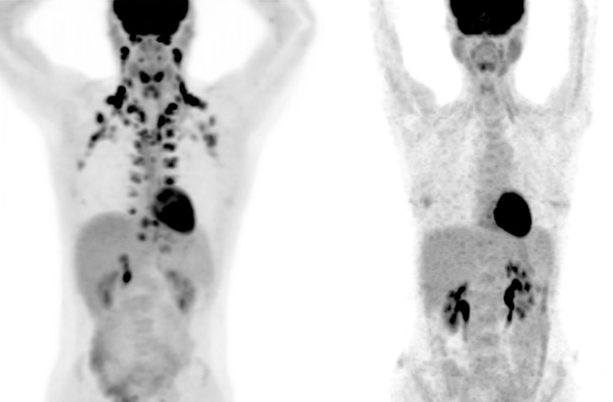 PET scans showing brown fat in two people