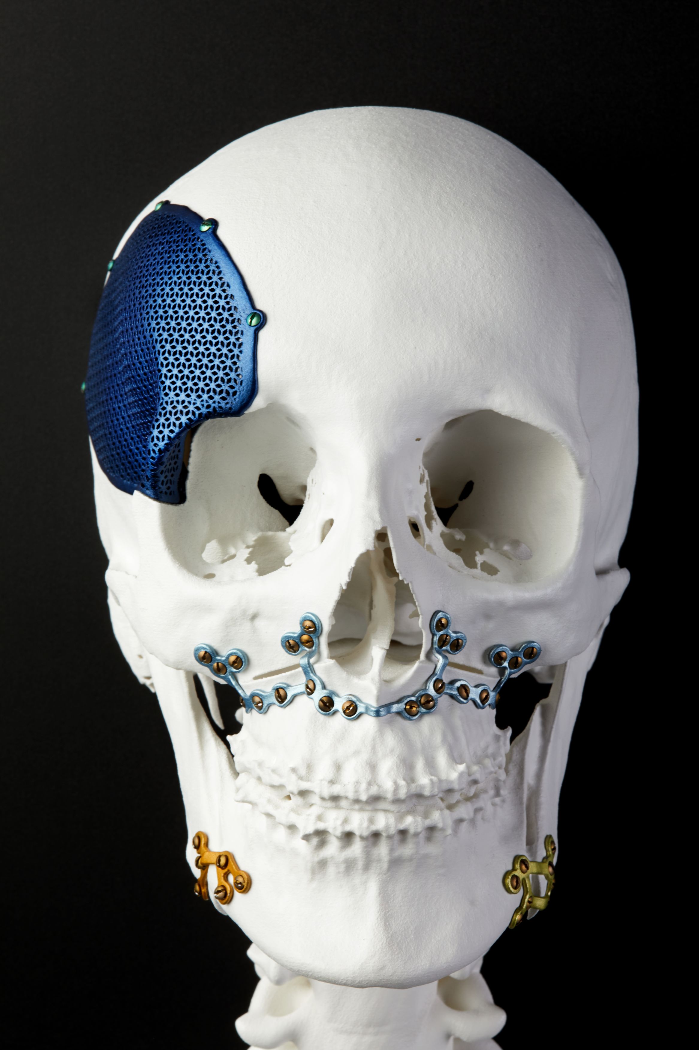 Bone Machine: 3D Is Plastic Surgery | GE News