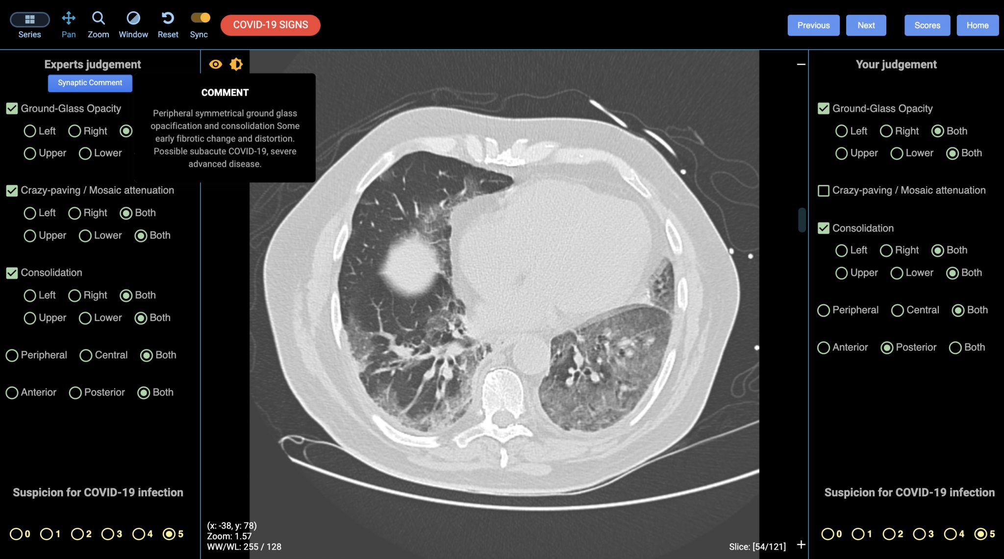 New online to quickly upskill CT diagnosis of COVID-19 | GE News