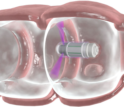  />Intrepid traveler: As it moves through the colon, the device transmits data to a wrist-worn receiver. No bowel cleansing required.<br />
<br />
</div><br />
Colorectal cancer is the third most common cancer in men and the second in women, according to the <a href=