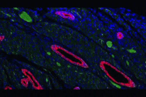  /><br />
<br />
<em>Triple-negative breast cancer has been defined by what it is not, but Dr. Jennifer Pietenpol and her team has identified six different subtypes of the disease.</em>