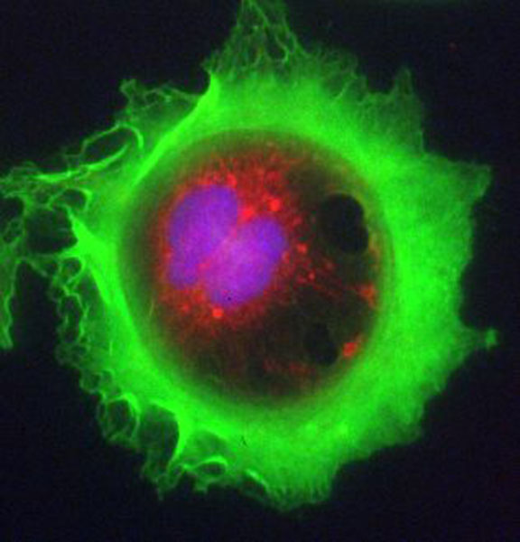 Description: Lung adenocarcinoma cell  stained for F-actin (green), mitochondria (red) and DNA (blue). Therapeutic focus: Cancer.