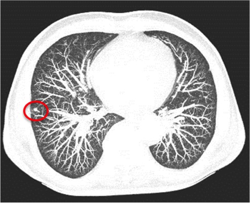 invasive ductal carcinoma what is it