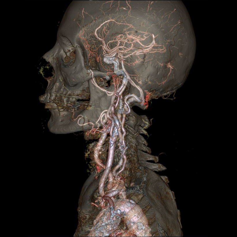 SkullCT
