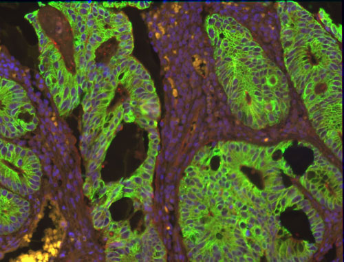 ColonCancerImage