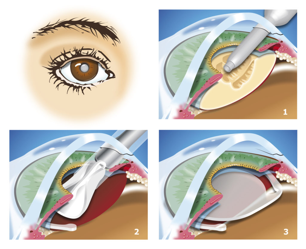 cataract