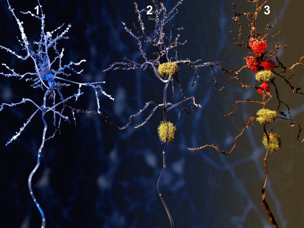 1. Healthy neuron. 2. Neuron with amyloid plaques (yellow). 3. Dead neuron being digested by microglia cells (red)