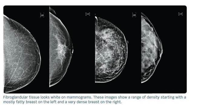Dense Breast