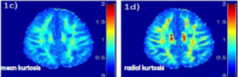  /></strong><br />
<br />
Dementia is now the most feared disease – ahead of cancers or heart disease. The study of the brain is the next frontier in medicine today, and <a href=