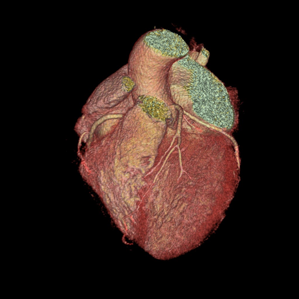  /><br />
<br />
<em>It has been virtually impossible to capture a clear diagnostic image of the heart in patients whose heart rate is extremely irregular. This vividly clear image, taken on GE's Revolution CT scanner by Spectrum Medical Imaging in Liverpool, NSW, shows the condition of a heart (and its blood vessels) that was beating at between 53 bpm and 126 bpm at the time of scanning. The Revolution CT successfully judged its fraction-of-a-second opportunity.</em><br />
<br />
The Revolution registers the wildly varying contractions between the patient’s heartbeats. Says Schlaphoff, “The thing is spinning, spinning, spinning, just watching, and it starts getting an idea that there’s a gap coming up, then phwataaa! That’s the shot!”<br />
<br />
The resulting image of this patient’s heart is the same quality as the Revolution would capture of an organ beating steadily, predictably at 60 bpm. It is so stunningly clear that it could be an anatomical drawing, glowing, showing in this case no coronary disease.<br />
<br />
It’s as if nothing much has happened...<br />
<br />
But, this patient, who had suspected coronary disease has, within 10 to 30 trauma-free minutes of preparation, 0.14 seconds of imaging and another 10 minutes or so of image construction, been cleared of the need for further coronary investigation.<br />
<blockquote>The Revolution’s expanded bore, at 80cm, is a mighty big doughnut which means there’s less likelihood that the patient will feel claustrophobic.</blockquote><br />
In the past, any CT scan of his heart would have been compromised by his uncontrollable heartbeat. The image may have been unreadable, inconclusive. He may have endured weeks or months of uncertainty, being sent instead for less conclusive ultrasound or magnetic resonance imaging (MRI). More likely, having been deemed unsuitable for CT, he would have had to undergo invasive coronary angiography—in which a catheter is inserted through an incision in the groin or elbow and manoeuvred up an artery until it reaches the heart, where it injects a dye directly into the coronary arteries in preparation for an x-ray image to be taken to show the condition of heart and vessels.<br />
<br />
Studies carried out in the US indicate that about 15% of patients who would benefit from coronary computed tomography angiography (CCTA) to assess their condition are too challenging or simply unsuitable for the procedure as was available on the previous generation of scanners. Other courses of investigation used to assess possible heart disease require correlation of various tests that can never be as clear CT imaging.<br />
<br />
“It’s a significant reduction of the burden on healthcare when you can put these patients onto the right path immediately,” says Samantha Barr, GE’s product marketing leader for Premium CT in the Asia Pacific region.<br />
<br />
An erratic heartbeat is just one of the contraindications for using CCTA. Other conditions that can render a patient unsuitable include rapid heartbeat and atrial fibrillation—a disturbance of the heart’s electrical system that causes the upper chambers of the heart to quiver rather than pump normally. People—most frequently young children—who can’t hold their breath for the 5 to 15 seconds required by most scanners to capture a clear picture have also been near impossible to scan.<br />
<br />
Breathing, or quivering or fast heart rates that cause constant movement of vessels result in images similar to what happens when you use a camera on slow shutter speed to take a photo of a friend doing star jumps.<br />
<br />
The majority of CT scanners in use can only capture compromised images of the hearts of such patients. “With the older generation of machines, if someone has a faster heart rate, it would be done over three to four heartbeats and then you’d piece the image back together,” explains Waldon. This, he adds can result in “misregistration artefacts—if there is a variation in the heartbeat, it doesn’t line up and you get blurring of the vessels”.<br />
<br />
He says Spectrum’s team of radiographers, “Almost cried when we realised how much time it [the Revolution CT] would save us, and that we could scan <em>everyone</em>.”<br />
<br />
Schlaphoff and Waldon say the Revolution CT offers several advantages over older models of scanner. The speed of the scanner—that 0.28-second rotation—is one thing, but the temporal resolution is also supported by Snapshot Freeze, GE’s intelligent motion-correction software, which allows the machine to easily be programmed to respond to different patient conditions. Importantly, the size of the Rev CT’s image detector, at 16 centimetres, is four times the size of most other CT detectors, which means it can capture an image of the whole heart in one revolution and in one heartbeat—rather than taking four image strips that later need to be assembled. This also reduces the ionising radiation (the part of the electromagnetic spectrum with sufficient energy to pass through matter) required to achieve an image—it’s achieved during one pass of the detector rather than four.<br />
<br />
Radiation dose has long been a barrier to the use of CT, particularly for young people who have a greater chance of developing cancer due to radiation within their lifetime, and for young women with heart problems, whose breast tissue would have been put at risk by canning of the chest with previous CT machines.<br />
<br />
“This young woman was only 21,” says Waldon, showing a vividly clear 3D image of a heart and turning it through 360 degrees. She’s got this minor heart defect, it’s like a fistula, an abnormal communication between two of the vessels in the chest and we were able to show it with really low-dose imaging.”<br />
<br />
In adjusting the settings of the Revolution CT, the Spectrum team has found it can achieve extremely high quality images with radiation doses as low as a single x-ray—that, says Schlaphoff, equates to the same radiation you’d receive on a flight from Australia to the US.<br />
<br />
“It’s satisfying to know, when people leave, that we’ve done no harm to them,” says Waldon. “You’re able to keep the doses low, but still answer the question that the doctor was asking, even in the most challenging of patients.”<br />
<br />
&nbsp;