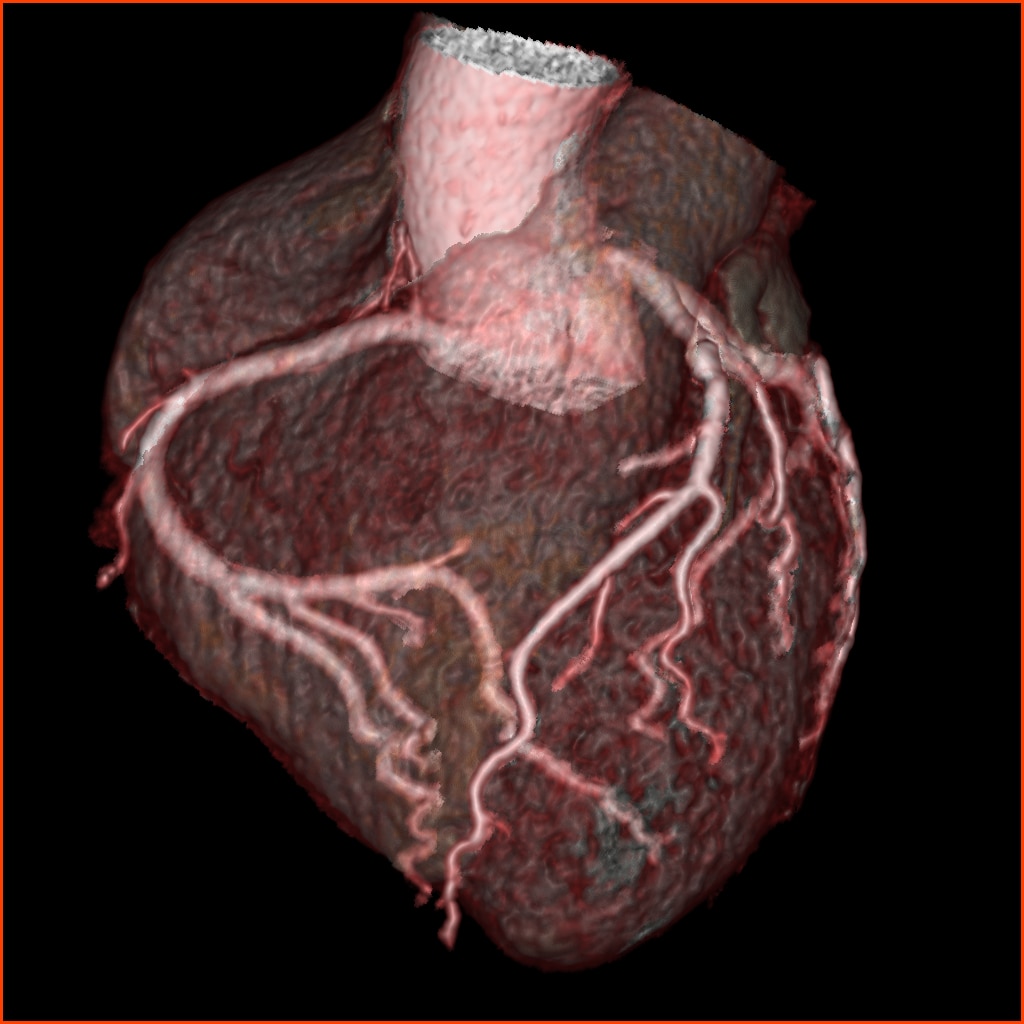 Heart Revolution CT GE Healthcare