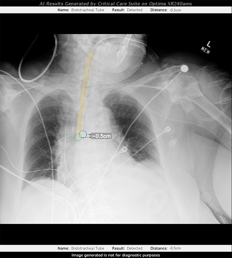 CCS 2.0 misplaced tube