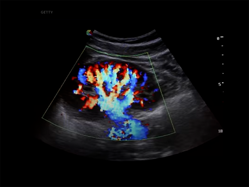 Ultrasound video