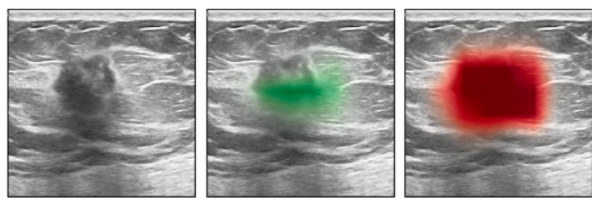 breast ultrasound AI
