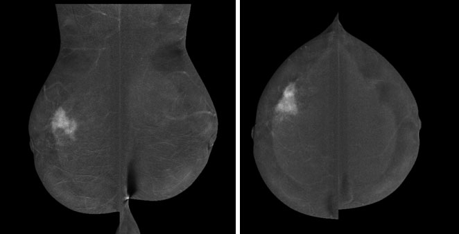 Contrast mammogram
