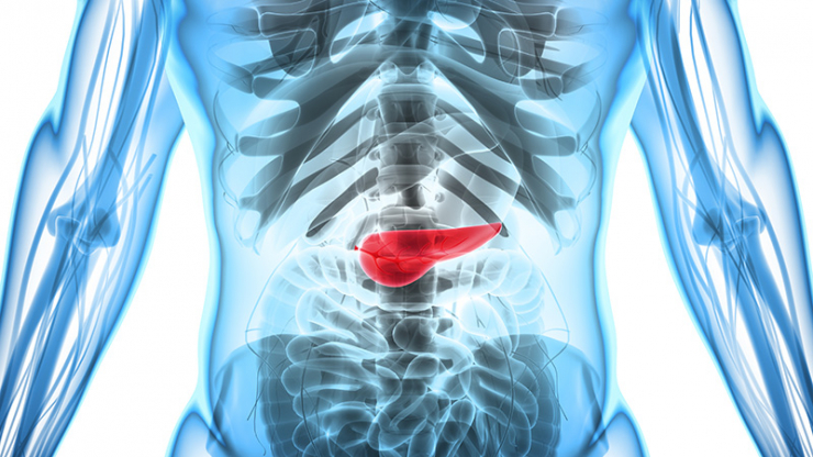 pancreatic cancer