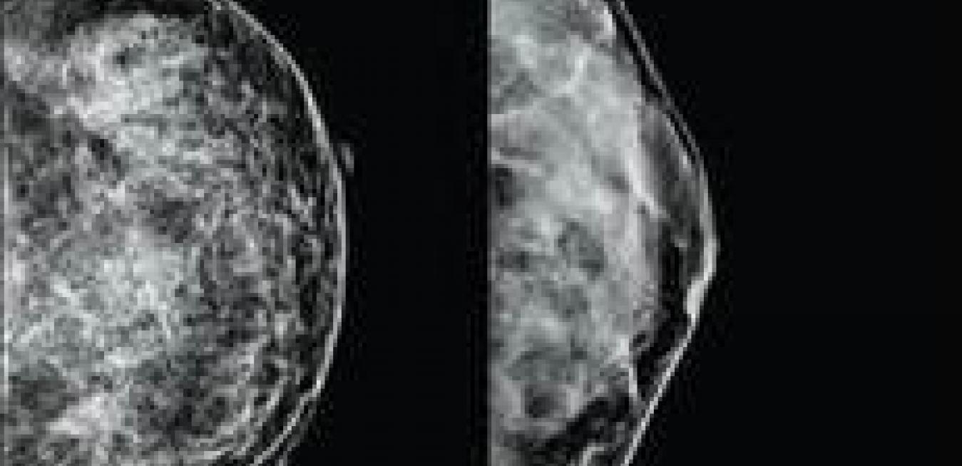 The Power Of An Image Best Practices For Examining Dense Breasts