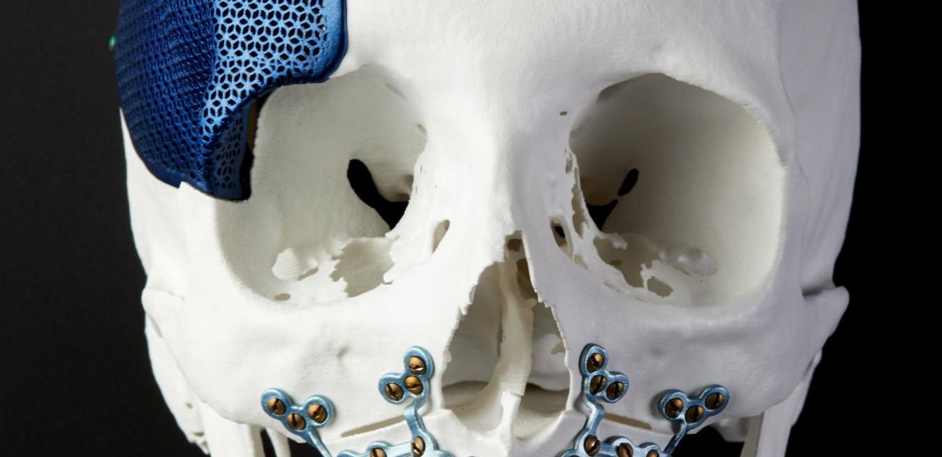 Bone Machine 3d Printing Is Revolutionizing Plastic Surgery Ge News