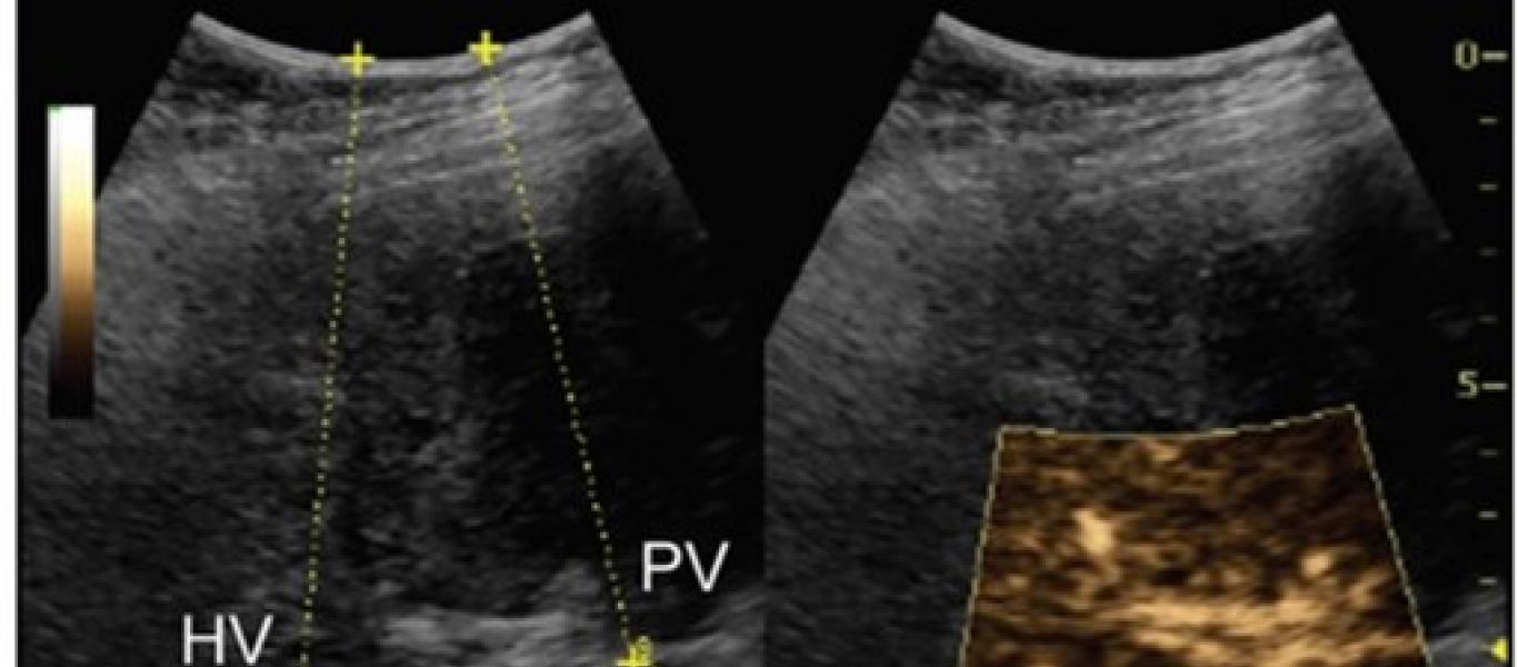 Ultrasound Imaging of Portal Hypertension Using Microbubbles image